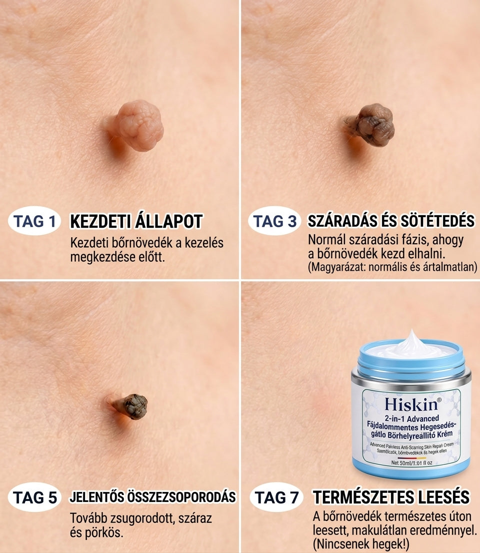𝐇𝐢𝐬𝐤𝐢𝐧® 2 az 1-ben fejlett, fájdalommentes és hegmentes bőrmegújító krém – bőrkinövések, szemölcsök és látható bőrhibák ellen
