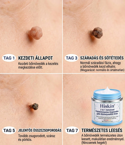 𝐇𝐢𝐬𝐤𝐢𝐧® 2 az 1-ben fejlett, fájdalommentes és hegmentes bőrmegújító krém – bőrkinövések, szemölcsök és látható bőrhibák ellen