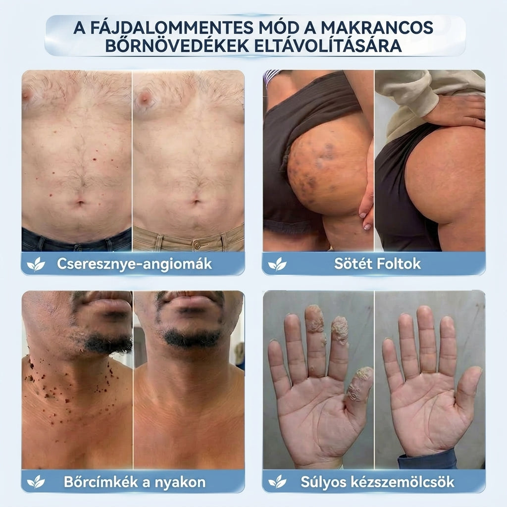𝐇𝐢𝐬𝐤𝐢𝐧® 2 az 1-ben fejlett, fájdalommentes és hegmentes bőrmegújító krém – bőrkinövések, szemölcsök és látható bőrhibák ellen