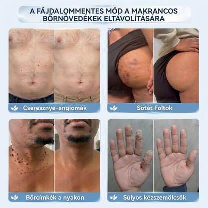 𝐇𝐢𝐬𝐤𝐢𝐧® 2 az 1-ben fejlett, fájdalommentes és hegmentes bőrmegújító krém – bőrkinövések, szemölcsök és látható bőrhibák ellen
