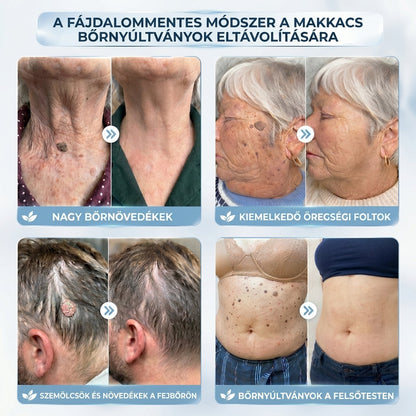 𝐇𝐢𝐬𝐤𝐢𝐧® 2 az 1-ben fejlett, fájdalommentes és hegmentes bőrmegújító krém – bőrkinövések, szemölcsök és látható bőrhibák ellen